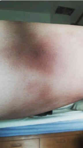 Bruised Thigh Muay Thai - Rambaa